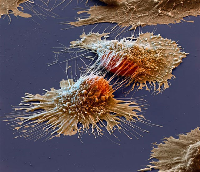 cellules cancéreuses sous un microscope